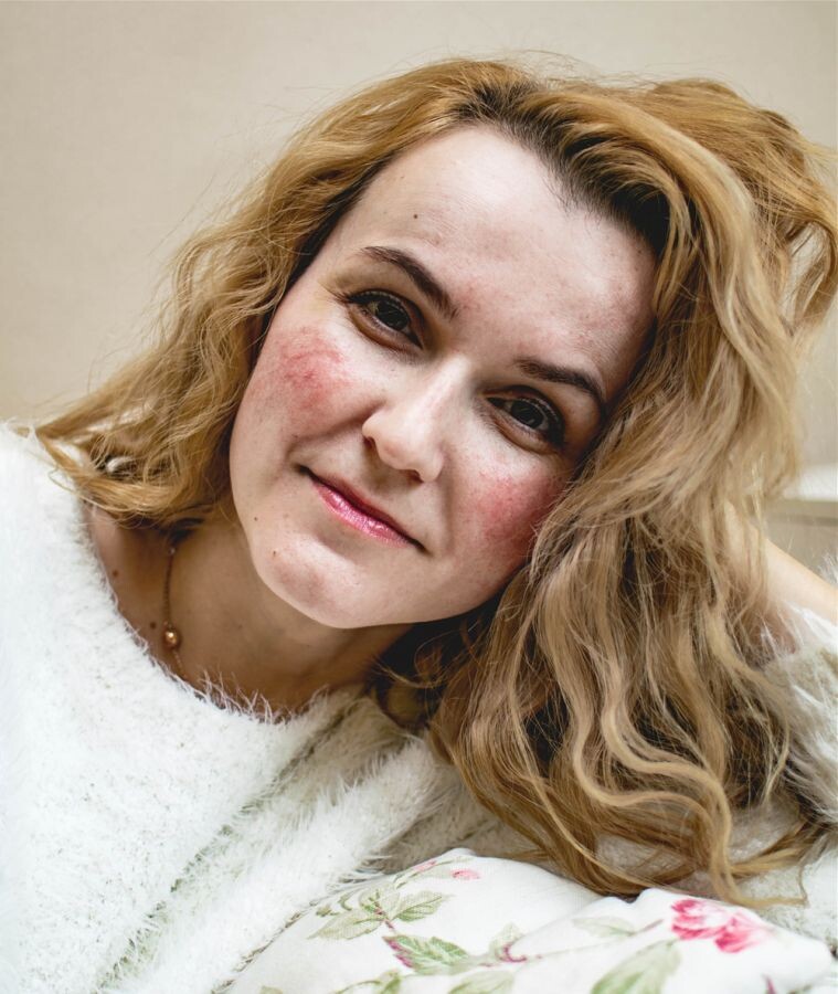 kniha rozsacea